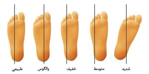 چرخش انگشتان پا به داخل و حرکات اصلاحی آن