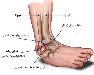 پای پیچ خورده وحرکات اصلاحی آن